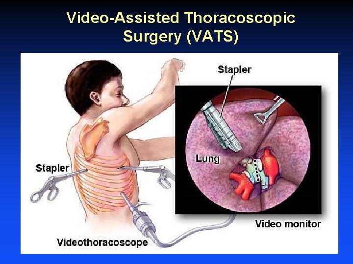 Video-Assisted Thoracoscopic Surgery (VATS) Video-Assisted Thoracoscopic Surgery (VATS)