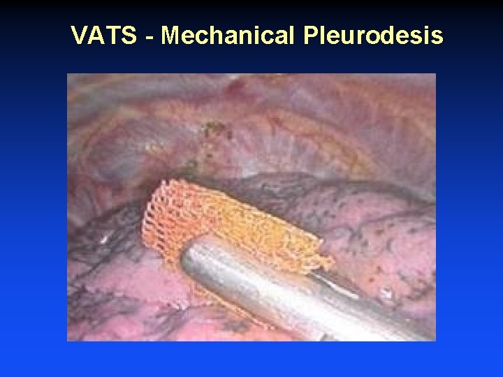 VATS - Mechanical Pleurodesis VATS - Mechanical Pleurodesis