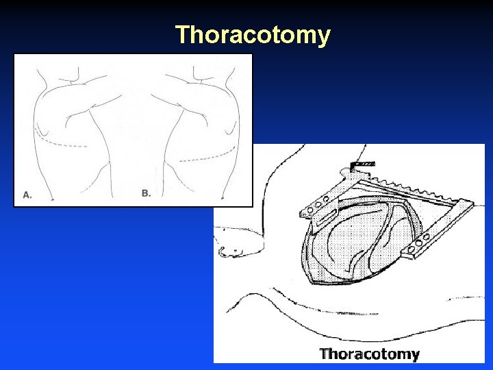 Thoracotomy 