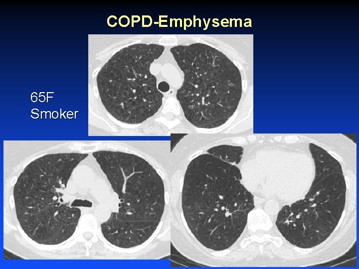 COPD-Emphysema 65 F Smoker 