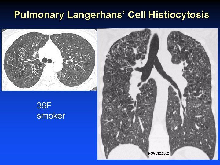 Pulmonary Langerhans’ Cell Histiocytosis 39 F smoker 