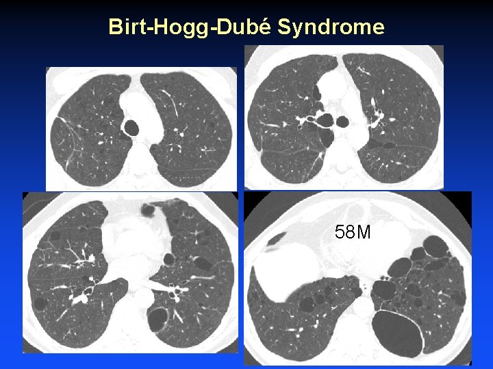 Birt-Hogg-Dubé Syndrome 58 M 