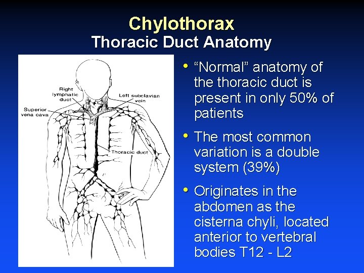 Chylothorax Thoracic Duct Anatomy • “Normal” anatomy of the thoracic duct is present in Chylothorax Thoracic Duct Anatomy • “Normal” anatomy of the thoracic duct is present in