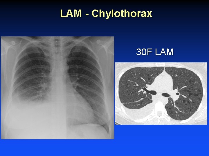 LAM - Chylothorax 30 F LAM LAM - Chylothorax 30 F LAM