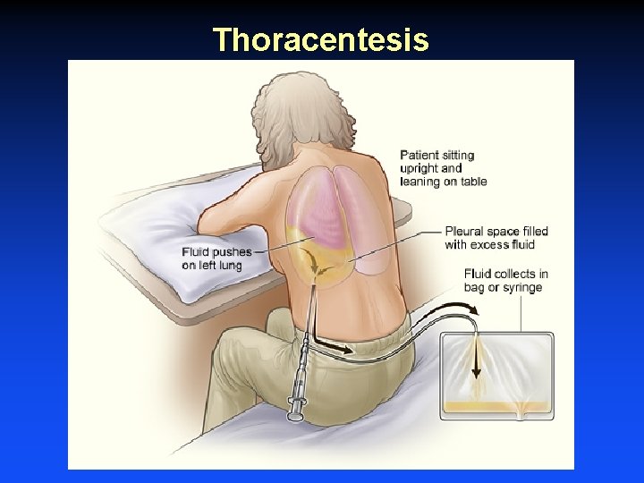 Thoracentesis Thoracentesis