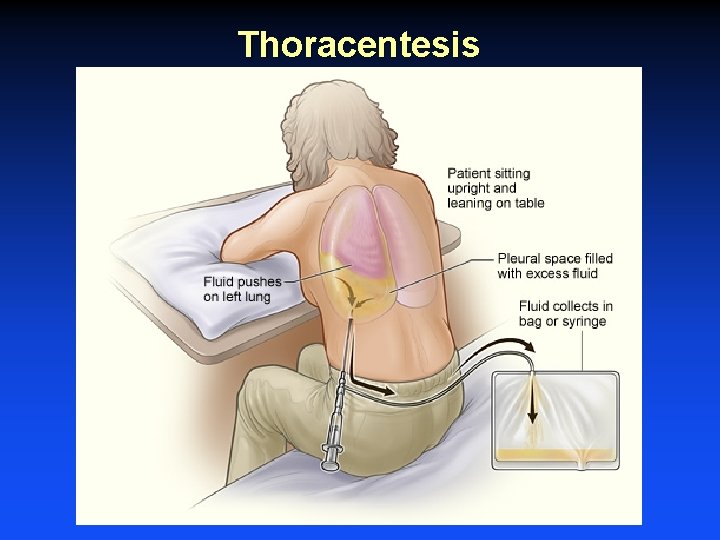 Thoracentesis 