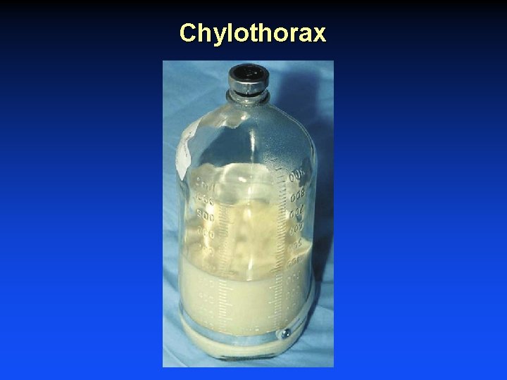 Chylothorax 
