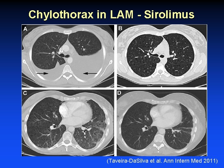 Chylothorax in LAM - Sirolimus (Taveira-Da. Silva et al. Ann Intern Med 2011) Chylothorax in LAM - Sirolimus (Taveira-Da. Silva et al. Ann Intern Med 2011)