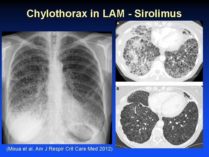 Chylothorax in LAM - Sirolimus (Moua et al. Am J Respir Crit Care Med
