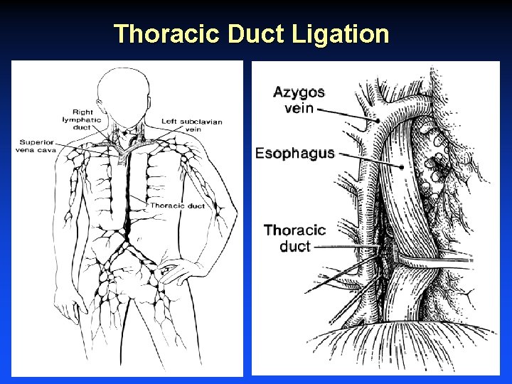 Thoracic Duct Ligation 