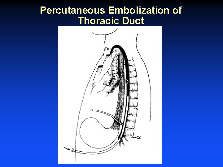 Percutaneous Embolization of Thoracic Duct Percutaneous Embolization of Thoracic Duct