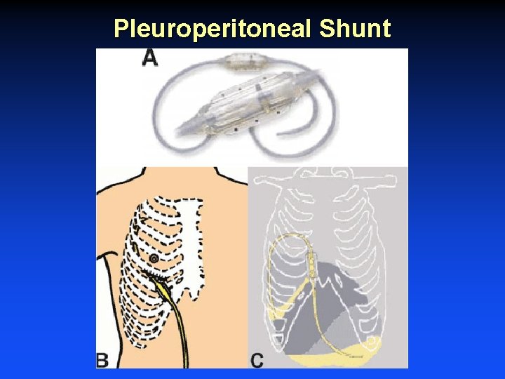 Pleuroperitoneal Shunt Pleuroperitoneal Shunt