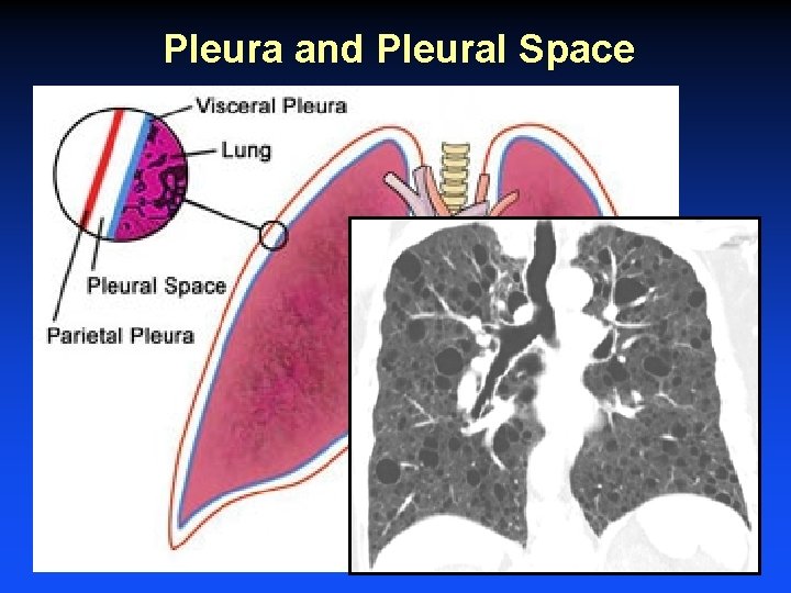 Pleura and Pleural Space Pleura and Pleural Space