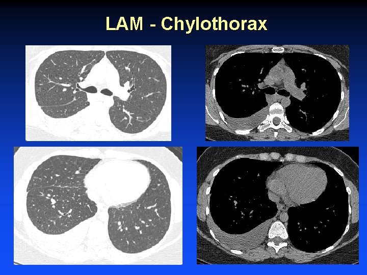 LAM - Chylothorax 