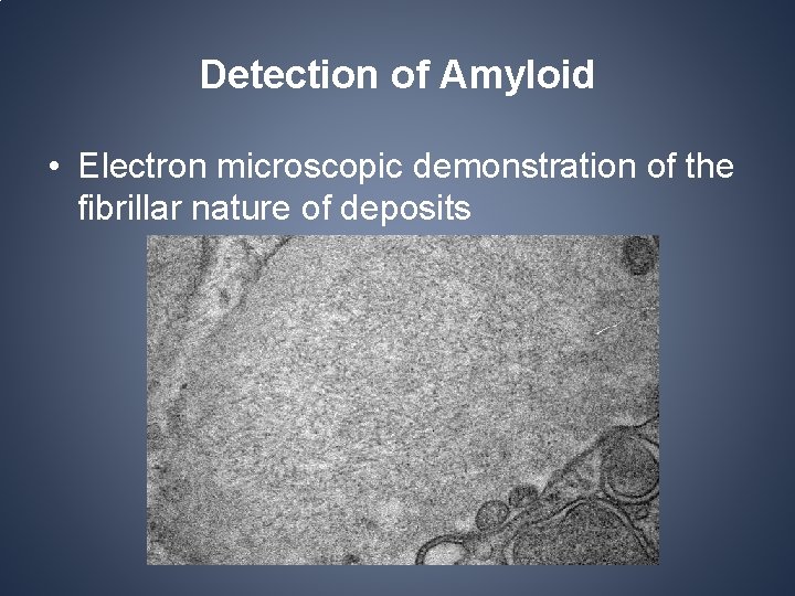 Detection of Amyloid • Electron microscopic demonstration of the fibrillar nature of deposits Detection of Amyloid • Electron microscopic demonstration of the fibrillar nature of deposits
