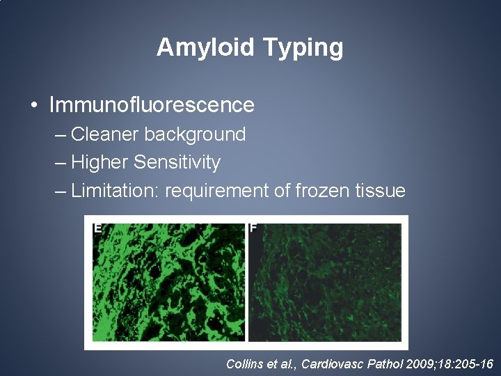 Amyloid Typing • Immunofluorescence – Cleaner background – Higher Sensitivity – Limitation: requirement of Amyloid Typing • Immunofluorescence – Cleaner background – Higher Sensitivity – Limitation: requirement of