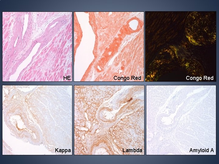 HE Congo Red Kappa Lambda Amyloid A HE Congo Red Kappa Lambda Amyloid A