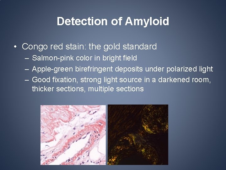 Detection of Amyloid • Congo red stain: the gold standard – Salmon-pink color in Detection of Amyloid • Congo red stain: the gold standard – Salmon-pink color in