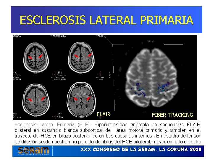ESCLEROSIS LATERAL PRIMARIA FLAIR FIBER-TRACKING Esclerosis Lateral Primaria (ELP)- Hiperintensidad anómala en secuencias FLAIR