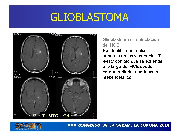 GLIOBLASTOMA Glioblastoma con afectación del HCE Se identifica un realce anómalo en las secuencias