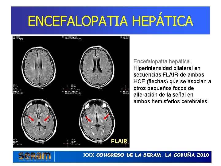 ENCEFALOPATIA HEPÁTICA Encefalopatía hepática. Hiperintensidad bilateral en secuencias FLAIR de ambos HCE (flechas) que