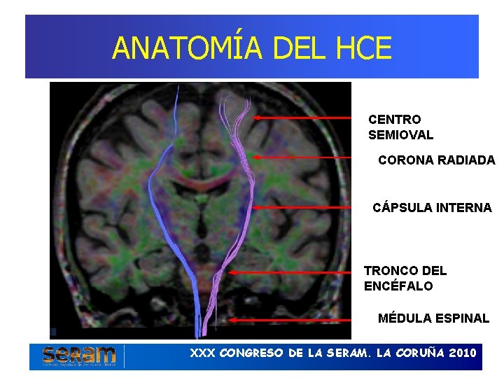 ANATOMÍA DEL HCE CENTRO SEMIOVAL CORONA RADIADA CÁPSULA INTERNA TRONCO DEL ENCÉFALO MÉDULA ESPINAL