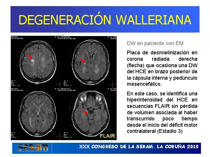 DEGENERACIÓN WALLERIANA DW en paciente con EM Placa de desmielinización en corona radiada derecha