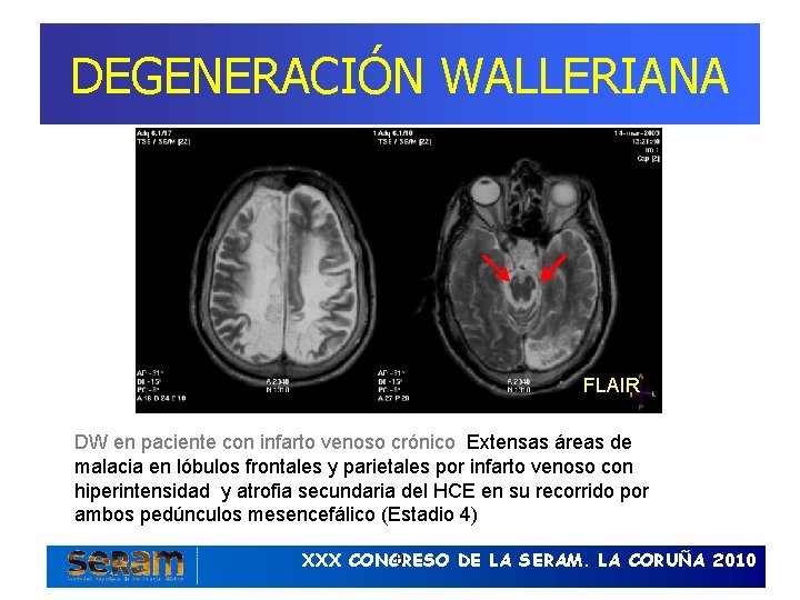 DEGENERACIÓN WALLERIANA FLAIR DW en paciente con infarto venoso crónico Extensas áreas de malacia
