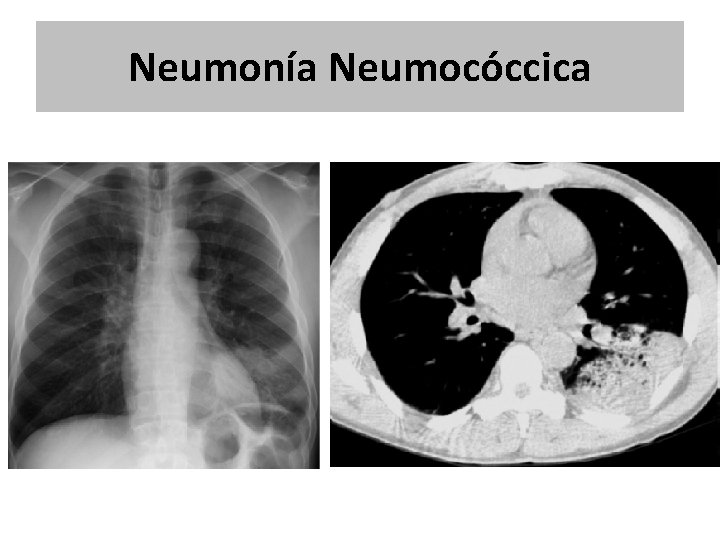 Neumonía Neumocóccica Neumonía Neumocóccica