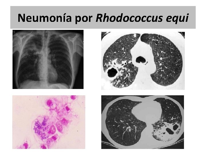Neumonía por Rhodococcus equi Neumonía por Rhodococcus equi