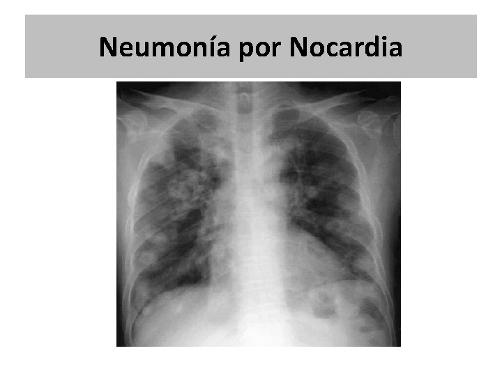 Neumonía por Nocardia Neumonía por Nocardia
