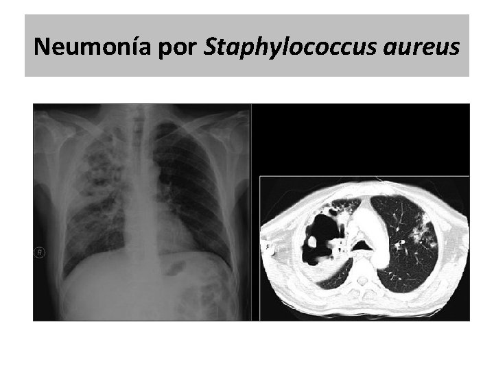 Neumonía por Staphylococcus aureus Neumonía por Staphylococcus aureus