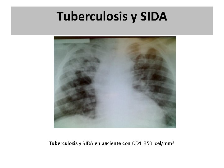Tuberculosis y SIDA en paciente con CD 4 350 cel/mm 3 Tuberculosis y SIDA en paciente con CD 4 350 cel/mm 3