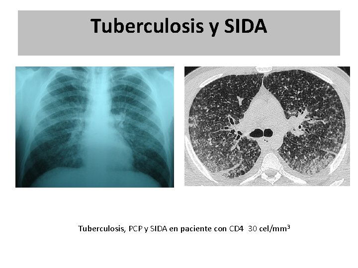 Tuberculosis y SIDA Tuberculosis, PCP y SIDA en paciente con CD 4 30 cel/mm Tuberculosis y SIDA Tuberculosis, PCP y SIDA en paciente con CD 4 30 cel/mm