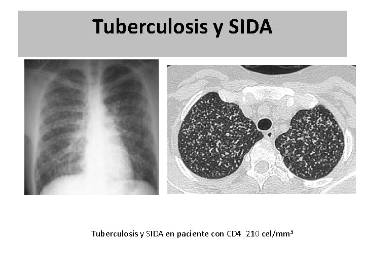 Tuberculosis y SIDA en paciente con CD 4 210 cel/mm 3 Tuberculosis y SIDA en paciente con CD 4 210 cel/mm 3