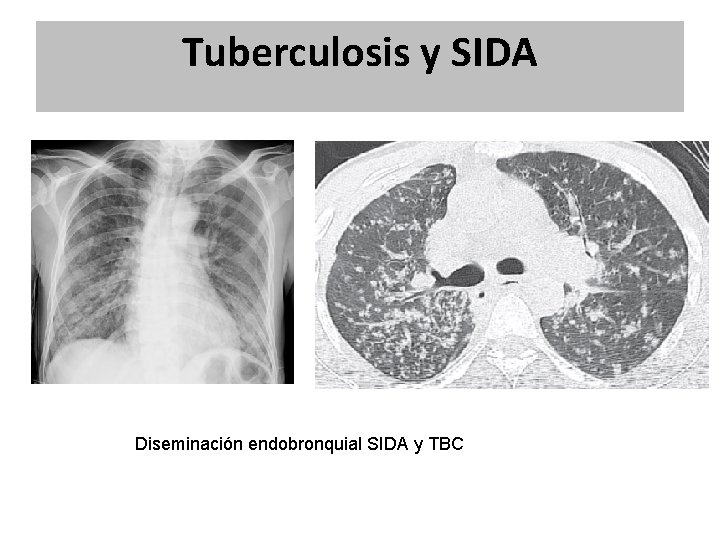 Tuberculosis y SIDA Diseminación endobronquial SIDA y TBC Tuberculosis y SIDA Diseminación endobronquial SIDA y TBC