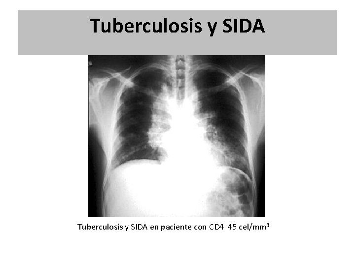 Tuberculosis y SIDA en paciente con CD 4 45 cel/mm 3 Tuberculosis y SIDA en paciente con CD 4 45 cel/mm 3