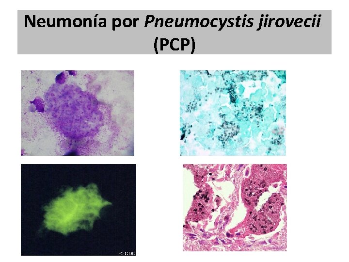 Neumonía por Pneumocystis jirovecii (PCP) Neumonía por Pneumocystis jirovecii (PCP)