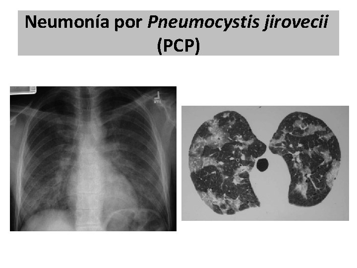 Neumonía por Pneumocystis jirovecii (PCP) Neumonía por Pneumocystis jirovecii (PCP)