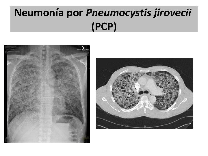 Neumonía por Pneumocystis jirovecii (PCP) Neumonía por Pneumocystis jirovecii (PCP)