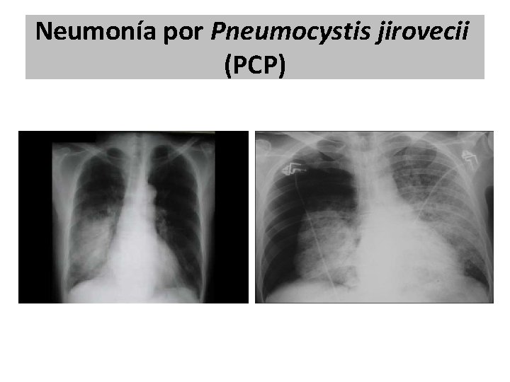 Neumonía por Pneumocystis jirovecii (PCP) Neumonía por Pneumocystis jirovecii (PCP)