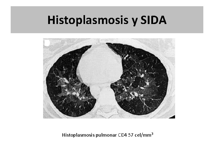 Histoplasmosis y SIDA Histoplasmosis pulmonar CD 4 57 cel/mm 3 Histoplasmosis y SIDA Histoplasmosis pulmonar CD 4 57 cel/mm 3