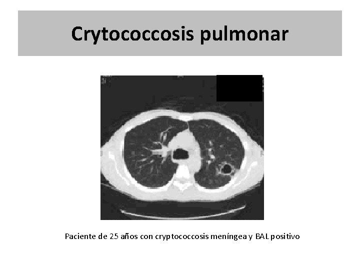Crytococcosis pulmonar Paciente de 25 años con cryptococcosis meníngea y BAL positivo Crytococcosis pulmonar Paciente de 25 años con cryptococcosis meníngea y BAL positivo