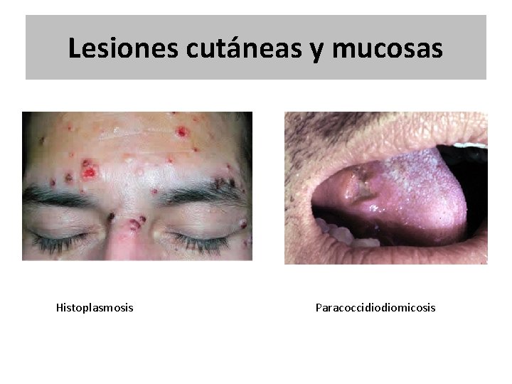 Lesiones cutáneas y mucosas Histoplasmosis Paracoccidiodiomicosis Lesiones cutáneas y mucosas Histoplasmosis Paracoccidiodiomicosis