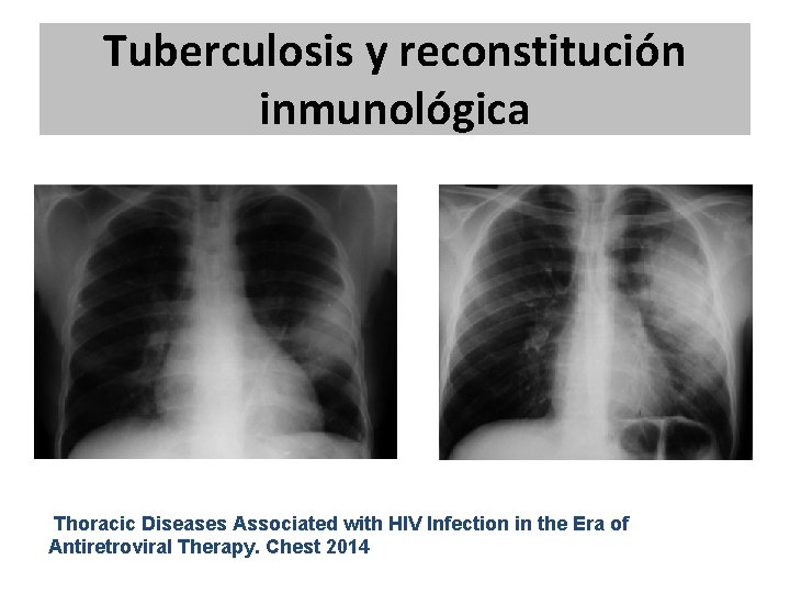 Tuberculosis y reconstitución inmunológica Thoracic Diseases Associated with HIV Infection in the Era of Tuberculosis y reconstitución inmunológica Thoracic Diseases Associated with HIV Infection in the Era of