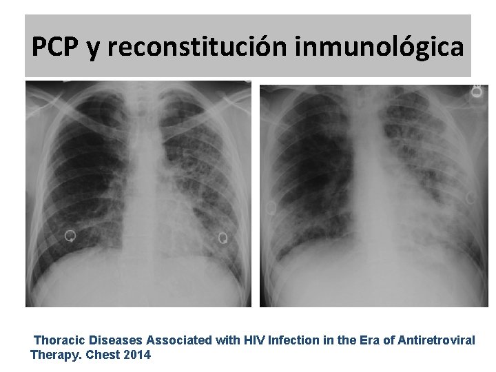 PCP y reconstitución inmunológica Thoracic Diseases Associated with HIV Infection in the Era of PCP y reconstitución inmunológica Thoracic Diseases Associated with HIV Infection in the Era of