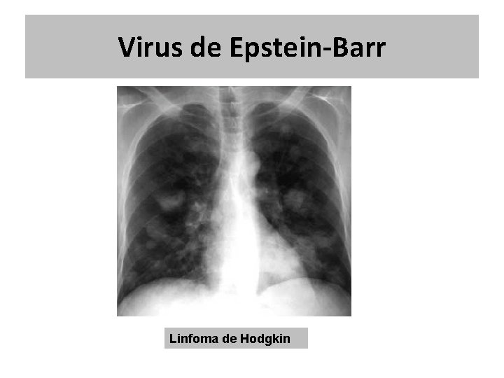 Virus de Epstein-Barr Linfoma de Hodgkin Virus de Epstein-Barr Linfoma de Hodgkin