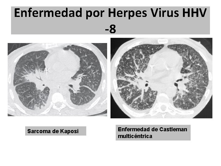 Enfermedad por Herpes Virus HHV -8 Sarcoma de Kaposi Enfermedad de Castleman multicéntrica Enfermedad por Herpes Virus HHV -8 Sarcoma de Kaposi Enfermedad de Castleman multicéntrica
