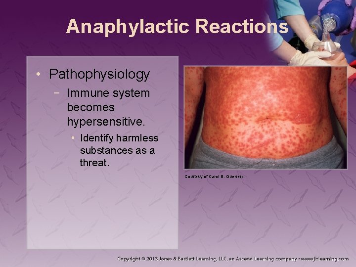 Anaphylactic Reactions • Pathophysiology − Immune system becomes hypersensitive. • Identify harmless substances as