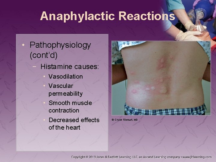 Anaphylactic Reactions • Pathophysiology (cont’d) − Histamine causes: • Vasodilation • Vascular permeability •